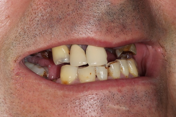 Before Invisalign Treatment Reading Smiles