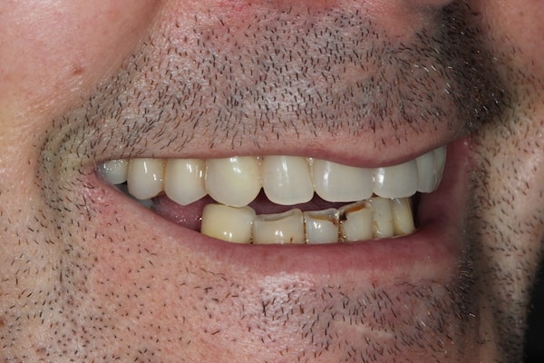 After Invisalign Treatment Reading Smiles