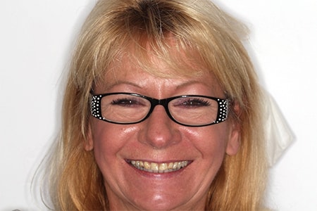 Before Smile Makeover Treatment Reading Smiles