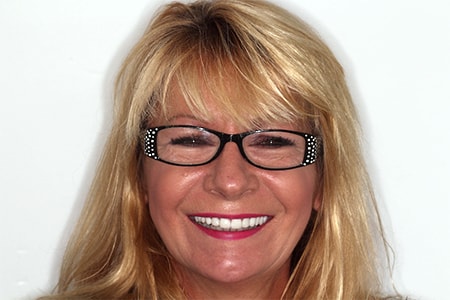 After Smile Makeover Treatment Reading Smiles