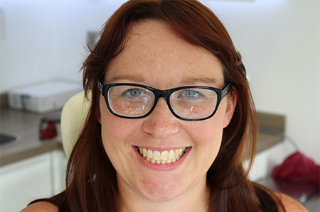 Before Invisalign Treatment Reading Smiles Before Invisalign Treatment Reading Smiles