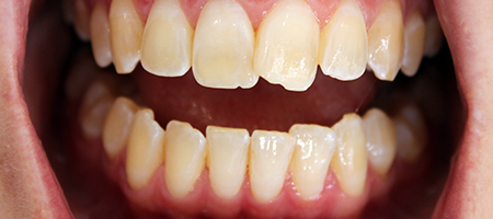 Before Invisalign Treatment Reading Smiles Before Invisalign Treatment Reading Smiles