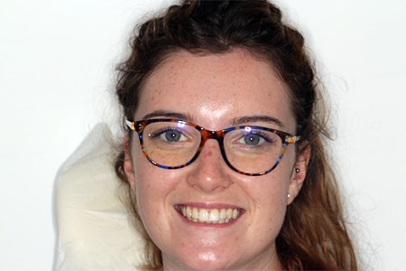 After Invisalign Treatment Reading Smiles After Invisalign Treatment Reading Smiles