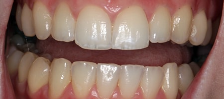 After Invisalign Treatment Reading Smiles After Invisalign Treatment Reading Smiles