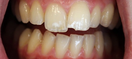 Before Invisalign Treatment Reading Smiles Before Invisalign Treatment Reading Smiles