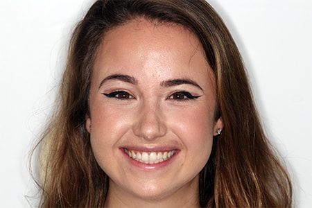 After Invisalign Treatment Reading Smiles After Invisalign Treatment Reading Smiles