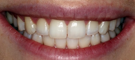 After Invisalign Treatment Reading Smiles After Invisalign Treatment Reading Smiles