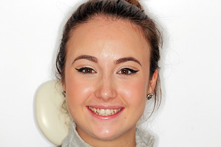 Before Invisalign Treatment Reading Smiles Before Invisalign Treatment Reading Smiles