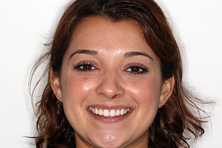 After Invisalign Treatment Reading Smiles After Invisalign Treatment Reading Smiles