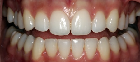After Invisalign Treatment Reading Smiles After Invisalign Treatment Reading Smiles