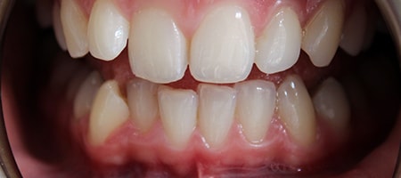 Before Invisalign Treatment Reading Smiles Before Invisalign Treatment Reading Smiles