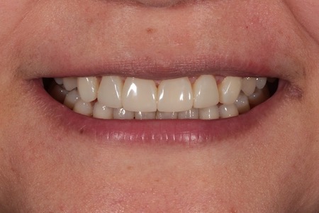 After Veneers Treatment Reading Smiles