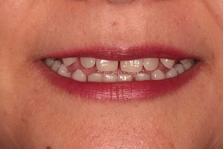 Before veneers Treatment Reading Smiles