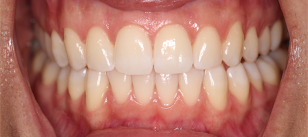 After Invisalign Treatment Reading Smiles After Invisalign Treatment Reading Smiles