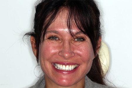 After Invisalign Treatment Reading Smiles After Invisalign Treatment Reading Smiles