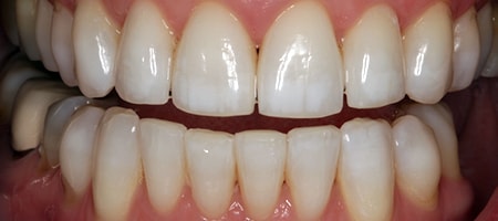 After Invisalign Treatment Reading Smiles After Invisalign Treatment Reading Smiles