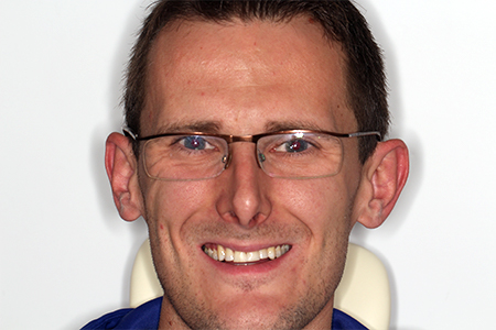 After Invisalign Treatment Reading Smiles After Invisalign Treatment Reading Smiles