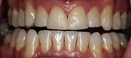 After Invisalign Treatment Reading Smiles After Invisalign Treatment Reading Smiles