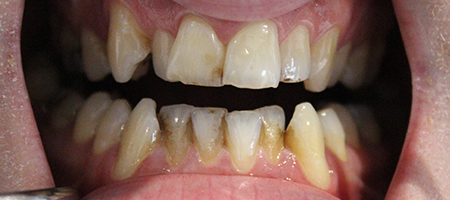 Before Invisalign Treatment Reading Smiles Before Invisalign Treatment Reading Smiles