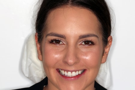 After Invisalign Treatment Reading Smiles After Invisalign Treatment Reading Smiles