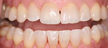 After Invisalign Treatment Reading Smiles After Invisalign Treatment Reading Smiles