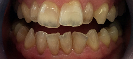 Before Invisalign Treatment Reading Smiles Before Invisalign Treatment Reading Smiles