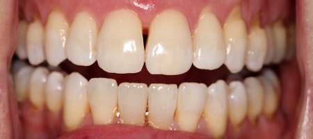 After Invisalign Treatment Reading Smiles After Invisalign Treatment Reading Smiles