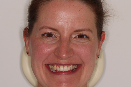 After Invisalign Treatment Reading Smiles After Invisalign Treatment Reading Smiles