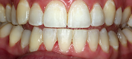 After Invisalign Treatment Reading Smiles After Invisalign Treatment Reading Smiles