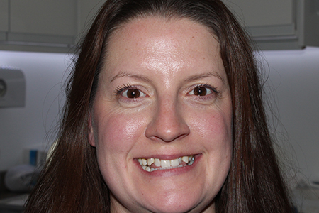 Before Invisalign Treatment Reading Smiles Before Invisalign Treatment Reading Smiles