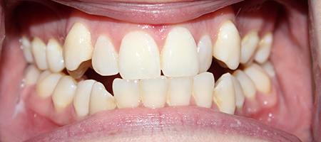 Before Invisalign Treatment Reading Smiles Before Invisalign Treatment Reading Smiles
