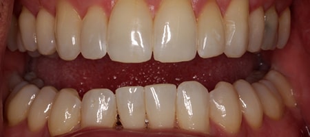 After Invisalign Treatment Reading Smiles After Invisalign Treatment Reading Smiles