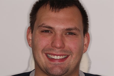 After Invisalign Treatment Reading Smiles After Invisalign Treatment Reading Smiles