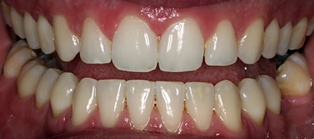 After Invisalign Treatment Reading Smiles After Invisalign Treatment Reading Smiles
