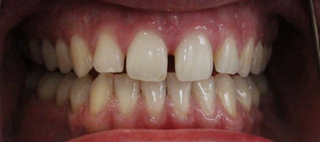 Before Invisalign Treatment Reading Smiles Before Invisalign Treatment Reading Smiles