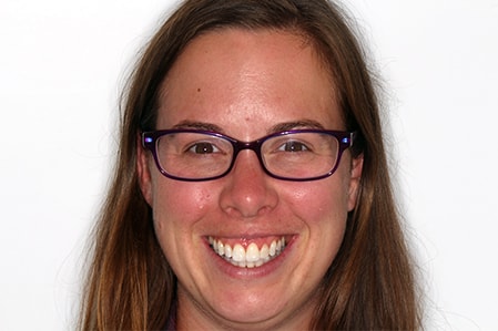 After Invisalign Treatment Reading Smiles After Invisalign Treatment Reading Smiles