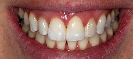 After Invisalign Treatment Reading Smiles After Invisalign Treatment Reading Smiles