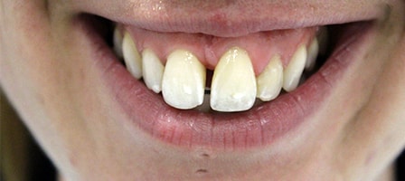 Before Invisalign Treatment Reading Smiles Before Invisalign Treatment Reading Smiles
