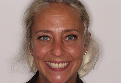 After Invisalign Treatment Reading Smiles After Invisalign Treatment Reading Smiles