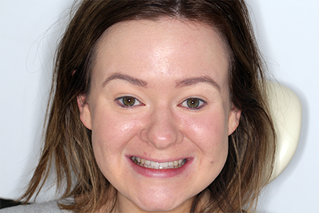 After Invisalign Treatment Reading Smiles After Invisalign Treatment Reading Smiles