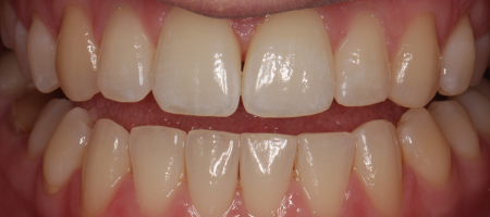 After Invisalign Treatment Reading Smiles After Invisalign Treatment Reading Smiles