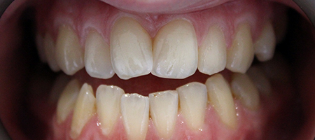Before Invisalign Treatment Reading Smiles Before Invisalign Treatment Reading Smiles