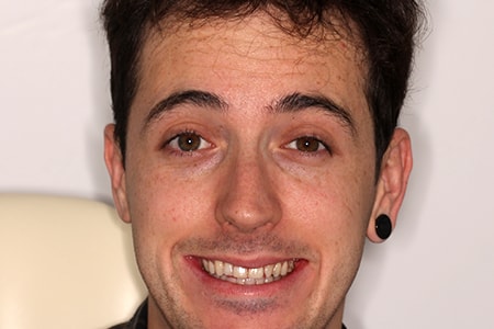 After Smile Makeover Treatment Reading Smiles