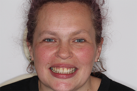 After Invisalign Treatment Reading Smiles After Invisalign Treatment Reading Smiles