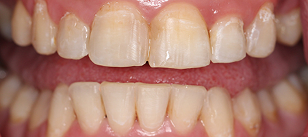 After Invisalign Treatment Reading Smiles After Invisalign Treatment Reading Smiles