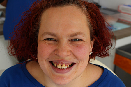 Before Invisalign Treatment Reading Smiles Before Invisalign Treatment Reading Smiles