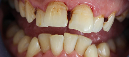 Before Invisalign Treatment Reading Smiles Before Invisalign Treatment Reading Smiles
