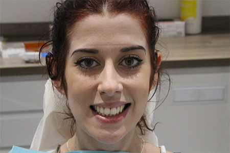 Before Smile Makeover Treatment Reading Smiles