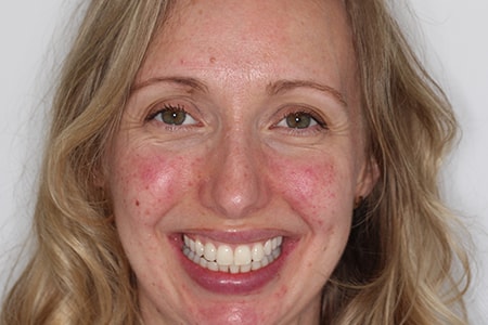 After Invisalign Treatment Reading Smiles After Invisalign Treatment Reading Smiles