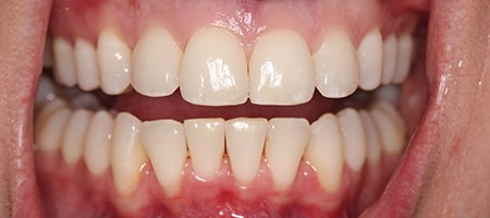 After Invisalign Treatment Reading Smiles After Invisalign Treatment Reading Smiles